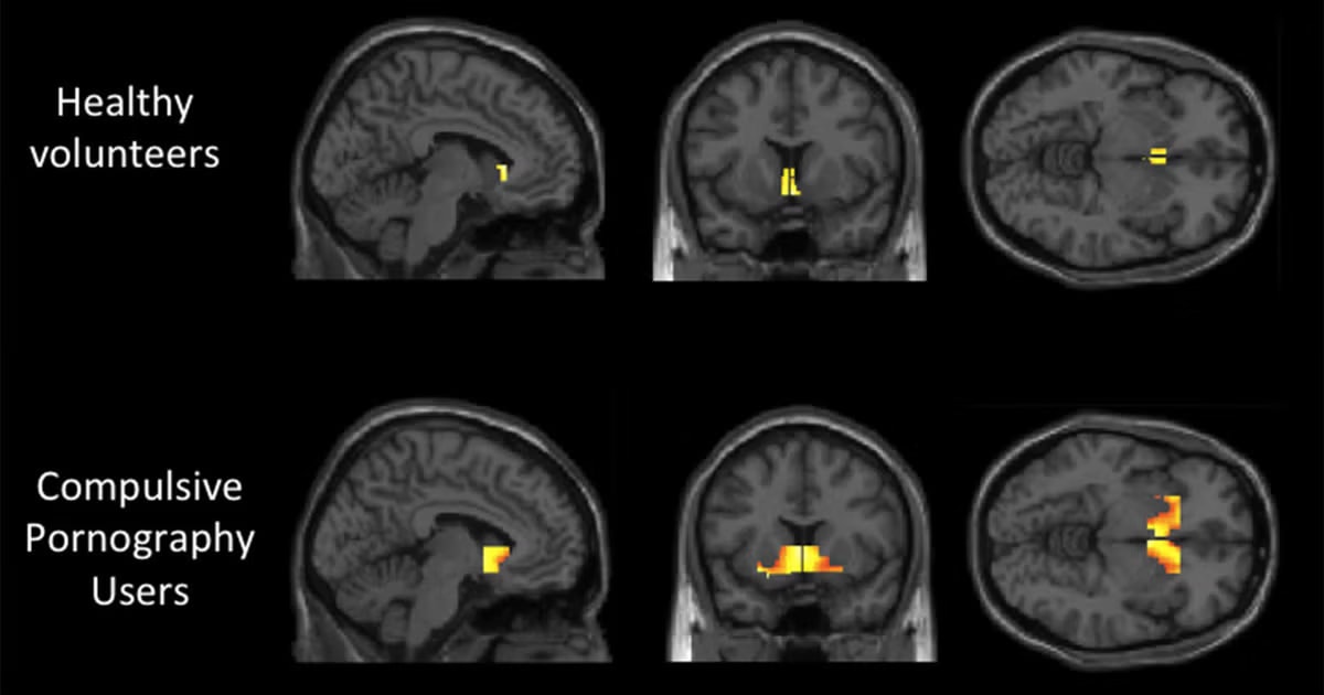 Infographic comparing brain activity before and after quitting porn